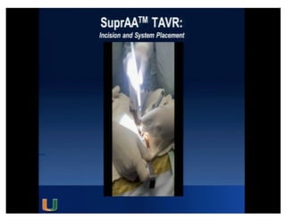 Cohen MG - AIMRADIAL 2014 - Radial and TAVI