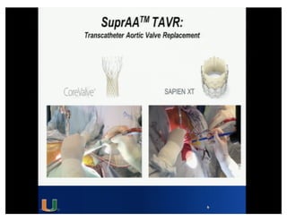 Cohen MG - AIMRADIAL 2014 - Radial and TAVI