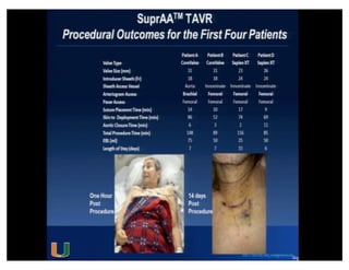 Cohen MG - AIMRADIAL 2014 - Radial and TAVI