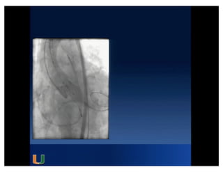 Cohen MG - AIMRADIAL 2014 - Radial and TAVI