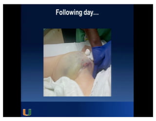 Cohen MG - AIMRADIAL 2014 - Radial and TAVI