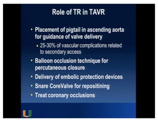 Cohen MG - AIMRADIAL 2014 - Radial and TAVI