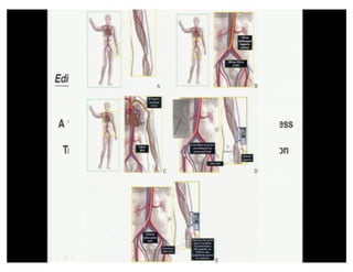 Cohen MG - AIMRADIAL 2014 - Radial and TAVI