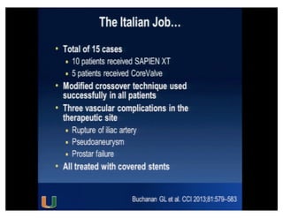 Cohen MG - AIMRADIAL 2014 - Radial and TAVI