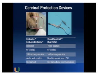 Cohen MG - AIMRADIAL 2014 - Radial and TAVI