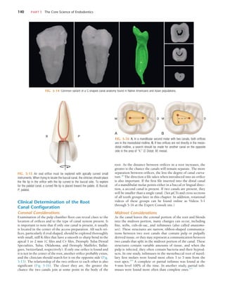 140	 PART I  The Core Science of Endodontics
root. As the distance between orifices in a root increases, the
greater is the chance the canals will remain separate. The more
separation between orifices, the less the degree of canal curva-
ture.40
The direction a file takes when introduced into an orifice
is also important. If the first file inserted into the distal canal
of a mandibular molar points either in a buccal or lingual direc-
tion, a second canal is present. If two canals are present, they
will be smaller than a single canal. (See µCTs and cross sections
of all tooth groups later in this chapter. In addition, rotational
videos of these groups can be found online as Videos 5-1
through 5-16 at the Expert Consult site.)
Midroot Considerations
As the canal leaves the coronal portion of the root and blends
into the midroot portion, many changes can occur, including
fins, webs, culs-de-sac, and isthmuses (also called anastomo-
ses). These structures are narrow, ribbon-shaped communica-
tions between two root canals that contain pulp or pulpally
derived tissue, or they may represent a communication between
two canals that split in the midroot portion of the canal. These
structures contain variable amounts of tissue, and when the
pulp is infected, they often contain bacteria and their byprod-
ucts. In one study, isthmuses in the mesiobuccal root of maxil-
lary first molars were found most often 3 to 5 mm from the
root apex.244
A complete or partial isthmus was found at the
4-mm level 100% of the time. In another study, partial isth-
muses were found more often than complete ones.213
Clinical Determination of the Root
Canal Configuration
Coronal Considerations
Examination of the pulp chamber floor can reveal clues to the
location of orifices and to the type of canal system present. It
is important to note that if only one canal is present, it usually
is located in the center of the access preparation. All such ori-
fices, particularly if oval shaped, should be explored thoroughly
with small, stiff K-files that have a smooth to sharp bend in the
apical 1 to 2 mm (C files and C+ files, Dentsply Tulsa Dental
Specialties, Tulsa, Oklahoma, and Dentsply Maillefer, Ballai-
gues, Switzerland, respectively). If only one orifice is found and
it is not in the center of the root, another orifice probably exists,
and the clinician should search for it on the opposite side (Fig.
5-15). The relationship of the two orifices to each other is also
significant (Fig. 5-16). The closer they are, the greater the
chance the two canals join at some point in the body of the
FIG. 5-14  Common variant of a C-shaped canal anatomy found in Native Americans and Asian populations.
FIG. 5-15  An oval orifice must be explored with apically curved small
instruments. When trying to locate the buccal canal, the clinician should place
the file tip in the orifice with the tip curved to the buccal side. To explore 
for the palatal canal, a curved file tip is placed toward the palate. B, Buccal;
P, palatal.
B P
FIG. 5-16  A, In a mandibular second molar with two canals, both orifices
are in the mesiodistal midline. B, If two orifices are not directly in the mesio-
distal midline, a search should be made for another canal on the opposite
side in the area of “X.” D, Distal; M, mesial.
M
X
D
M D
A B
 