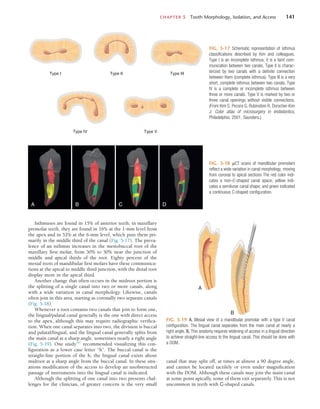 CHAPTER 5  Tooth Morphology, Isolation, and Access	 141
Isthmuses are found in 15% of anterior teeth; in maxillary
premolar teeth, they are found in 16% at the 1-mm level from
the apex and in 52% at the 6-mm level, which puts them pri-
marily in the middle third of the canal (Fig. 5-17). The preva-
lence of an isthmus increases in the mesiobuccal root of the
maxillary first molar, from 30% to 50% near the junction of
middle and apical thirds of the root. Eighty percent of the
mesial roots of mandibular first molars have these communica-
tions at the apical to middle third junction, with the distal root
display more in the apical third.
Another change that often occurs in the midroot portion is
the splitting of a single canal into two or more canals, along
with a wide variation in canal morphology. Likewise, canals
often join in this area, starting as coronally two separate canals
(Fig. 5-18).
Whenever a root contains two canals that join to form one,
the lingual/palatal canal generally is the one with direct access
to the apex, although this may require radiographic verifica-
tion. When one canal separates into two, the division is buccal
and palatal/lingual, and the lingual canal generally splits from
the main canal at a sharp angle, sometimes nearly a right angle
(Fig. 5-19). One study197
recommended visualizing this con-
figuration as a lower case letter “h”. The buccal canal is the
straight-line portion of the h; the lingual canal exists about
midroot at a sharp angle from the buccal canal. In these situ-
ations modification of the access to develop an unobstructed
passage of instruments into the lingual canal is indicated.
Although the splitting of one canal into two presents chal-
lenges for the clinician, of greater concern is the very small
FIG. 5-17  Schematic representation of isthmus
classifications described by Kim and colleagues.
Type I is an incomplete isthmus; it is a faint com-
munication between two canals. Type II is charac-
terized by two canals with a definite connection
between them (complete isthmus). Type III is a very
short, complete isthmus between two canals. Type
IV is a complete or incomplete isthmus between
three or more canals. Type V is marked by two or
three canal openings without visible connections.
(From Kim S, Pecora G, Rubinstein R, Dorscher-Kim
J: Color atlas of microsurgery in endodontics,
Philadelphia, 2001, Saunders.)
Type I Type II Type III
Type V
Type IV
FIG. 5-18  µCT scans of mandibular premolars
reflect a wide variation in canal morphology, moving
from coronal to apical sections The red color indi-
cates a non–C-shaped canal space; yellow indi-
cates a semilunar canal shape; and green indicated
a continuous C-shaped configuration.
A B C D
FIG. 5-19  A, Mesial view of a mandibular premolar with a type V canal
configuration. The lingual canal separates from the main canal at nearly a
right angle. B, This anatomy requires widening of access in a lingual direction
to achieve straight-line access to the lingual canal. This should be done with
a DOM.
A
B
canal that may split off, at times at almost a 90 degree angle,
and cannot be located tactilely or even under magnification
with the DOM. Although these canals may join the main canal
at some point apically, some of them exit separately. This is not
uncommon in teeth with C-shaped canals.
 