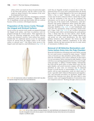 146	 PART I  The Core Science of Endodontics
teeth that are lingually inclined or rotated, this is often the
preferred choice for access and is performed before the dental
dam is placed, or careful alignment of the root is determined
before a bur is used.84
Likewise, initial access through
crowns may be better achieved without a dental dam in place
so that the inclination of the root can be visualized; this
information can be used as an indicator of the direction of
the long axis of the treated tooth. Furthermore, canal iden-
tification and partial enlargement before dental dam place-
ment may be beneficial in some cases. The Micro-Opener
(Dentsply Maillefer) (Fig. 5-25, A) and EndoHandle with
Find and File instruments (Venta Innovative Dental Prod-
ucts, Logan, Utah) (Fig. 5-25, B) are excellent instruments
for locating canal orifices and developing the canal pathway
when a dental dam has not been placed. These flexible,
stainless steel hand instruments have variably tapered tips
and permit not only canal identification, but also initial
pathway formation when indicated. The former has offset
handles that provide enhanced visualization of the pulp
chamber, whereas the latter permits the use of a wide variety
of instruments of different sizes.
Removal of All Defective Restorations and
Caries before Entry Into the Pulp Chamber
Removal of all defective restorations and caries before entering
the root canal system is essential for many reasons.84
Hidden
caries or fractures are often identified, and the ability to deter-
mine the restorability of the tooth is enhanced. In this respect
it is not uncommon, before entering the pulp chamber, to stop
with the access opening preparation in favor of a crown length-
ening procedure or adding a bonded buildup. Subsequently,
the tooth will be much easier to isolate before entry into the
pulp chamber, and sound restorative margins will have been
identified. In some cases, an extraction may be indicated
because of tooth fracture or unrestorability (Fig. 5-26). Ulti-
mately, with an open preparation, canals are much easier to
locate, especially under enhanced illumination and magnifica-
tion, and intracanal procedures are facilitated. Studies have
indicated that clinicians were about 40% more likely to miss
fractures, caries, and marginal breakdown if restorations were
not completely removed.1
Working through a clean access also
orifices of the root canals are always located at the angles
in the floor-wall junction; and the orifices of the root
canals are always located at the terminus of the roots’
developmental fusion lines.
More than 95% of the teeth these investigators examined
conformed to these spatial relationships.107
Slightly less than
5% of mandibular second and third molars did not conform
because of the occurrence of C-shaped anatomy.
Preparation of the Access Cavity Through
the Lingual and Occlusal Surfaces
Access cavities on anterior teeth usually are prepared through
the lingual tooth surface, and those on posterior teeth are
prepared through the occlusal surface. These approaches are
the best for achieving straight-line access while reducing
esthetic and restorative concerns. Some authors have recom-
mended that the traditional anterior access for mandibular
incisors be moved from the lingual surface to the incisal
surface in selected cases135
; this allows better access to the
lingual canal and improves canal débridement (Fig. 5-24). In
FIG. 5-24  An incisal access cavity on mandibular anterior teeth may allow
for improved straight-line access and canal débridement.
FIG. 5-25  A, Set of Micro-Openers (Dentsply Maillefer) for canal identification and enlargement. B, Similar tool
but with changeable instruments that are placed in the EndoHandle (Courtesy Venta Endo) and can be positioned
straight or at different angles.
A B
 