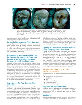 CHAPTER 5  Tooth Morphology, Isolation, and Access	 147
and endodontic endoscopes12
are also available to help in locat-
ing intricate root canal systems. In most cases, after dental dam
placement, in addition to magnification, a sharp endodontic
explorer (DG-16) is used to locate canal orifices and to deter-
mine their angle of departure from the pulp chamber.
Tapering of Cavity Walls and Evaluation of
Space Adequacy for a Coronal Seal
A proper access cavity generally has tapering walls, with its
widest dimension at the occlusal surface. In such a preparation,
occlusal forces do not push the temporary restoration into
the cavity and disrupt the seal. A minimum 3.5 mm of tempo-
rary filling material (e.g., Cavit; 3M ESPE, St. Paul, Minnesota)
is needed to provide an adequate coronal seal for a short
time.237
Recently, canal orifice plugs of composite, glass
ionomer, and mineral trioxide aggregate (ProRoot MTA, Dent-
sply Tulsa Dental Specialties) have shown promise in reducing
the risk of bacterial contamination of the canal system when
microleakage occurs at the coronal-restorative margins.96
MECHANICAL PHASES OF ACCESS
CAVITY PREPARATION
The preparation of an access cavity requires the following
equipment:
•	 Magnification and illumination
•	 Handpieces
•	 Burs
•	 Endodontic explorers
•	 Endodontic spoon
•	 Ultrasonic unit and tips
Magnification and Illumination
The access cavity is best prepared with the use of magnifica-
tion and an appropriate light source. In lieu of a DOM,
surgical loupes with an auxiliary light source are highly
recommended.
Handpieces
Good tactile awareness is essential to perform most phases of
access preparation with a high-speed handpiece. In many cases,
prevents restorative debris from becoming dislodged and inad-
vertently pushed into the canal system.
Removal of Unsupported Tooth Structure
Along with the removal of caries and restorations, unsupported
tooth structure should be removed to prevent tooth fracture
during or between procedures. Although unnecessary removal
of sound tooth structure should be avoided, oftentimes the
access shape may have to be modified to facilitate canal loca-
tion and intracanal procedures.
Preparation of Access Cavity Walls that
Do Not Restrict Straight- or Direct-Line
Passage of Instruments to the Apical
Foramen or Initial Canal Curvature
Sufficient tooth structure must be removed to allow instru-
ments to be placed easily into each canal orifice without inter-
ference from canal walls, particularly when a canal curves
severely or leaves the chamber floor at an obtuse angle. Hence,
access design depends not only on the orifice location, but also
on the position and curvature of the entire canal. The walls of
the root canal, rather than the walls of the access preparation,
must guide the passage of instruments into the canal. Failure
to follow this guideline results in treatment errors, including
root perforation, misdirection of an instrument from the main
canal (ledge formation), instrument separation, or creation of
an incorrect canal shape (apical transportation).
Inspection of the Pulp Chamber Walls
and Floor
Magnification is particularly important during initial root canal
procedures, especially for determining the location of canals
and removing tissue and calcifications from the pulp chamber.
Illumination provided by the use of many magnification tools,
in particular the DOM, aids in the initial negotiation of con-
stricted, curved, and partially calcified canals. Enhanced vision
allows the clinician to see internal dentin color changes and
subtle landmarks that may not be visible to the unaided eye,
including previously hidden cracks and decay. Surgical loupes
FIG. 5-26  A, Maxillary molar requiring root canal procedure. B, Removal of the amalgam reveals a vertical
fracture on the palatal margin. C, Complete cleaning and shaping of the canals. Fracture lines are still visible,
but no probings are present. (From Gutmann JL, Lovdahl PE: Problem solving in endodontics, ed 5, St Louis,
2011, Elsevier.)
A B C
C
 