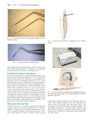 150	 PART I  The Core Science of Endodontics
canal enlargement and shaping phase; however, when done
before deep canal penetration, it establishes a well-prepared
access opening and may prevent subsequent error.
Endodontic Explorer and Spoon
Various hand instruments are useful for preparing access cavi-
ties. The DG-16 endodontic explorer (Fig. 5-34, A) is used to
identify canal orifices and to determine canal angulation. An
alternative, the JW-17 endodontic explorer (Fig. 5-34, B) (CK
Dental Industries, Orange, California) serves the same purpose,
but its thinner, stiffer tip can be useful for identifying the pos-
sible location of a calcified canal. A sharp endodontic spoon,
which comes in different sizes (Fig. 5-35) can be used to
remove coronal pulp and carious dentin. A #17 operative
explorer, which can also be found as a doubled-ended instru-
ment with the DG-16, is useful for detecting any remaining
overhang from the pulp chamber roof, particularly in the area
of a pulp horn of anterior teeth (Fig. 5-36). Failure to remove
this overhang, along with the propensity for it to harbor tissue
debris, often leads to tooth discoloration, especially in teeth
restored only with bonded palatal composite.
Ultrasonic Unit and Tips
Ultrasonic units (Fig. 5-37) and tips specifically designed for
activities during access opening preparation are extremely
valuable. Ultrasonic tips from various manufacturers can be
used to trough and deepen developmental grooves, remove
tissue, and explore for canals. Ultrasonic systems provide
FIG. 5-34  A, Access instruments: DG-16 endodontic explorer. B, JW-17
endodontic explorer.
A
B
FIG. 5-35  Access instrument: Endodontic spoon.
FIG. 5-36  Removal of the pulp horn is evaluated with a #17 operative
explorer.
FIG. 5-37  A, Endo ultrasonic unit (MiniEndo II). B, ProUltra Piezo Ultrasonic.
(A courtesy SybronEndo, Orange, Calif; B courtesy DENTSPLY Tulsa Dental
Specialties, Tulsa, Okla.)
A
B
outstanding visibility compared with traditional handpiece
heads, which typically obstruct vision. Fine ultrasonic tips,
such as Sine Tips, ProUltra Tips, and Smart X BUC Tips
(Dentsply Tulsa Dental Specialties; Dentsply Maillefer; and
SybronEndo, respectively), are smaller than round burs, and
their abrasive coatings or variable surfaces permit careful
shaving away of dentin and calcifications during exploration
for canal orifices.
 
