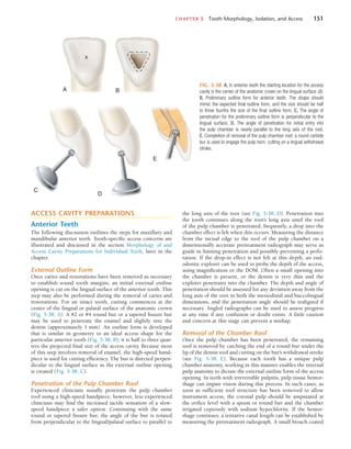 CHAPTER 5  Tooth Morphology, Isolation, and Access	 151
the long axis of the root (see Fig. 5-38, D). Penetration into
the tooth continues along the root’s long axis until the roof
of the pulp chamber is penetrated; frequently, a drop into the
chamber effect is felt when this occurs. Measuring the distance
from the incisal edge to the roof of the pulp chamber on a
dimensionally accurate pretreatment radiograph may serve as
guide in limiting penetration and possibly preventing a perfo-
ration. If the drop-in effect is not felt at this depth, an end-
odontic explorer can be used to probe the depth of the access,
using magnification or the DOM. Often a small opening into
the chamber is present, or the dentin is very thin and the
explorer penetrates into the chamber. The depth and angle of
penetration should be assessed for any deviation away from the
long axis of the root in both the mesiodistal and buccolingual
dimensions, and the penetration angle should be realigned if
necessary. Angled radiographs can be used to assess progress
at any time if any confusion or doubt exists. A little caution
and concern at this stage can prevent a mishap.
Removal of the Chamber Roof
Once the pulp chamber has been penetrated, the remaining
roof is removed by catching the end of a round bur under the
lip of the dentin roof and cutting on the bur’s withdrawal stroke
(see Fig. 5-38, E). Because each tooth has a unique pulp
chamber anatomy, working in this manner enables the internal
pulp anatomy to dictate the external outline form of the access
opening. In teeth with irreversible pulpitis, pulp tissue hemor-
rhage can impair vision during this process. In such cases, as
soon as sufficient roof structure has been removed to allow
instrument access, the coronal pulp should be amputated at
the orifice level with a spoon or round bur and the chamber
irrigated copiously with sodium hypochlorite. If the hemor-
rhage continues, a tentative canal length can be established by
measuring the pretreatment radiograph. A small broach coated
ACCESS CAVITY PREPARATIONS
Anterior Teeth
The following discussion outlines the steps for maxillary and
mandibular anterior teeth. Tooth-specific access concerns are
illustrated and discussed in the section Morphology of and
Access Cavity Preparations for Individual Teeth, later in the
chapter.
External Outline Form
Once caries and restorations have been removed as necessary
to establish sound tooth margins, an initial external outline
opening is cut on the lingual surface of the anterior tooth. This
step may also be performed during the removal of caries and
restorations. For an intact tooth, cutting commences at the
center of the lingual or palatal surface of the anatomic crown
(Fig. 5-38, A). A #2 or #4 round bur or a tapered fissure bur
may be used to penetrate the enamel and slightly into the
dentin (approximately 1 mm). An outline form is developed
that is similar in geometry to an ideal access shape for the
particular anterior tooth (Fig. 5-38, B); it is half to three quar-
ters the projected final size of the access cavity. Because most
of this step involves removal of enamel, the high-speed hand-
piece is used for cutting efficiency. The bur is directed perpen-
dicular to the lingual surface as the external outline opening
is created (Fig. 5-38, C).
Penetration of the Pulp Chamber Roof
Experienced clinicians usually penetrate the pulp chamber
roof using a high-speed handpiece; however, less experienced
clinicians may find the increased tactile sensation of a slow-
speed handpiece a safer option. Continuing with the same
round or tapered fissure bur, the angle of the bur is rotated
from perpendicular to the lingual/palatal surface to parallel to
FIG. 5-38  A, In anterior teeth the starting location for the access
cavity is the center of the anatomic crown on the lingual surface (X).
B, Preliminary outline form for anterior teeth. The shape should
mimic the expected final outline form, and the size should be half
to three fourths the size of the final outline form. C, The angle of
penetration for the preliminary outline form is perpendicular to the
lingual surface. D, The angle of penetration for initial entry into
the pulp chamber is nearly parallel to the long axis of the root. 
E, Completion of removal of the pulp chamber roof; a round carbide
bur is used to engage the pulp horn, cutting on a lingual withdrawal
stroke.
A
X
B
C
D
E
 
