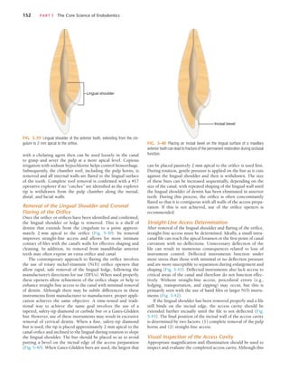 152	 PART I  The Core Science of Endodontics
can be placed passively 2 mm apical to the orifice is used first.
During rotation, gentle pressure is applied on the bur as it cuts
against the lingual shoulder and then is withdrawn. The size
of these burs can be increased sequentially, depending on the
size of the canal, with repeated shaping of the lingual wall until
the lingual shoulder of dentin has been eliminated in anterior
teeth. During this process, the orifice is often concomitantly
flared so that it is contiguous with all walls of the access prepa-
ration. If this is not achieved, use of the orifice openers is
recommended.
Straight-Line Access Determination
After removal of the lingual shoulder and flaring of the orifice,
straight-line access must be determined. Ideally, a small intra-
canal file can reach the apical foramen or the first point of canal
curvature with no deflections. Unnecessary deflection of the
file can result in numerous consequences related to loss of
instrument control. Deflected instruments function under
more stress than those with minimal or no deflection pressure
and are more susceptible to separation during enlargement and
shaping (Fig. 5-41). Deflected instruments also lack access to
critical areas of the canal and therefore do not function effec-
tively. Without straight-line access, procedural errors (e.g.,
ledging, transportation, and zipping) may occur, but this is
primarily seen with the use of hand files or larger NiTi instru-
ments (Fig. 5-42).
If the lingual shoulder has been removed properly and a file
still binds on the incisal edge, the access cavity should be
extended further incisally until the file is not deflected (Fig.
5-43). The final position of the incisal wall of the access cavity
is determined by two factors: (1) complete removal of the pulp
horns and (2) straight-line access.
Visual Inspection of the Access Cavity
Appropriate magnification and illumination should be used to
inspect and evaluate the completed access cavity. Although this
with a chelating agent then can be used loosely in the canal
to grasp and sever the pulp at a more apical level. Copious
irrigation with sodium hypochlorite helps control hemorrhage.
Subsequently, the chamber roof, including the pulp horns, is
removed and all internal walls are flared to the lingual surface
of the tooth. Complete roof removal is confirmed with a #17
operative explorer if no “catches” are identified as the explorer
tip is withdrawn from the pulp chamber along the mesial,
distal, and facial walls.
Removal of the Lingual Shoulder and Coronal
Flaring of the Orifice
Once the orifice or orifices have been identified and confirmed,
the lingual shoulder or ledge is removed. This is a shelf of
dentin that extends from the cingulum to a point approxi-
mately 2 mm apical to the orifice (Fig. 5-39). Its removal
improves straight-line access and allows for more intimate
contact of files with the canal’s walls for effective shaping and
cleaning. In addition, its removal from mandibular anterior
teeth may often expose an extra orifice and canal.
The contemporary approach to flaring the orifice involves
the use of rotary nickel-titanium (NiTi) orifice openers that
allow rapid, safe removal of the lingual ledge, following the
manufacturer’s directions for use (DFUs). When used properly,
these openers allow refinement of the orifice shape or help to
enhance straight-line access to the canal with minimal removal
of dentin. Although there may be subtle differences in these
instruments from manufacturer to manufacturer, proper appli-
cation achieves the same objective. A time-tested and tradi-
tional way to achieve the same goal involves the use of a
tapered, safety-tip diamond or carbide bur or a Gates-Glidden
bur. However, use of these instruments may result in excessive
removal of cervical dentin. When a fine, safety-tip diamond
bur is used, the tip is placed approximately 2 mm apical to the
canal orifice and inclined to the lingual during rotation to slope
the lingual shoulder. The bur should be placed so as to avoid
putting a bevel on the incisal edge of the access preparation
(Fig. 5-40). When Gates-Glidden burs are used, the largest that
FIG. 5-40  Placing an incisal bevel on the lingual surface of a maxillary
anterior tooth can lead to fracture of the permanent restoration during occlusal
function.
Incisal bevel
Lingual shoulder
FIG. 5-39  Lingual shoulder of the anterior tooth, extending from the cin-
gulum to 2 mm apical to the orifice.
 