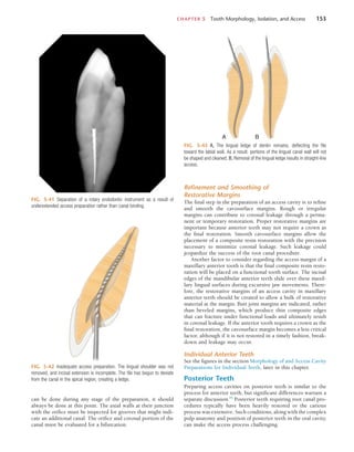 CHAPTER 5  Tooth Morphology, Isolation, and Access	 153
Refinement and Smoothing of
Restorative Margins
The final step in the preparation of an access cavity is to refine
and smooth the cavosurface margins. Rough or irregular
margins can contribute to coronal leakage through a perma-
nent or temporary restoration. Proper restorative margins are
important because anterior teeth may not require a crown as
the final restoration. Smooth cavosurface margins allow the
placement of a composite resin restoration with the precision
necessary to minimize coronal leakage. Such leakage could
jeopardize the success of the root canal procedure.
Another factor to consider regarding the access margin of a
maxillary anterior tooth is that the final composite resin resto-
ration will be placed on a functional tooth surface. The incisal
edges of the mandibular anterior teeth slide over these maxil-
lary lingual surfaces during excursive jaw movements. There-
fore, the restorative margins of an access cavity in maxillary
anterior teeth should be created to allow a bulk of restorative
material at the margin. Butt joint margins are indicated, rather
than beveled margins, which produce thin composite edges
that can fracture under functional loads and ultimately result
in coronal leakage. If the anterior tooth requires a crown as the
final restoration, the cavosurface margin becomes a less critical
factor, although if it is not restored in a timely fashion, break-
down and leakage may occur.
Individual Anterior Teeth
See the figures in the section Morphology of and Access Cavity
Preparations for Individual Teeth, later in this chapter.
Posterior Teeth
Preparing access cavities on posterior teeth is similar to the
process for anterior teeth, but significant differences warrant a
separate discussion.84
Posterior teeth requiring root canal pro-
cedures typically have been heavily restored or the carious
process was extensive. Such conditions, along with the complex
pulp anatomy and position of posterior teeth in the oral cavity,
can make the access process challenging.
FIG. 5-41  Separation of a rotary endodontic instrument as a result of
underextended access preparation rather than canal binding.
FIG. 5-42  Inadequate access preparation. The lingual shoulder was not
removed, and incisal extension is incomplete. The file has begun to deviate
from the canal in the apical region, creating a ledge.
FIG. 5-43  A, The lingual ledge of dentin remains, deflecting the file
toward the labial wall. As a result, portions of the lingual canal wall will not
be shaped and cleaned. B, Removal of the lingual ledge results in straight-line
access.
A B
can be done during any stage of the preparation, it should
always be done at this point. The axial walls at their junction
with the orifice must be inspected for grooves that might indi-
cate an additional canal. The orifice and coronal portion of the
canal must be evaluated for a bifurcation.
 