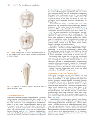 154	 PART I  The Core Science of Endodontics
for this tilt (Fig. 5-46). In mandibular first premolars, the start-
ing location is halfway up the lingual incline of the buccal cusp
on a line connecting the cusp tips. Mandibular second premo-
lars require less of an adjustment because they have less lingual
inclination. The starting location for this tooth is one third the
way up the lingual incline of the buccal cusp on a line con-
necting the buccal cusp tip and the lingual groove between the
lingual cusps.
To determine the starting location for molar access cavity
preparations, the mesial-distal and apical-coronal boundary
limitations for this outline must be determined (Fig. 5-47).
Evaluation of bite-wing radiographs is an accurate method of
assessing the mesiodistal extensions of the pulp chamber (Fig.
5-48). The mesial boundary for both the maxillary and man-
dibular molars is a line connecting the mesial cusp tips. Pulp
chambers are rarely found mesial to this imaginary line. A good
initial distal boundary for maxillary molars is the oblique
ridge. For mandibular molars, the initial distal boundary is a
line connecting the buccal and lingual grooves. For molars the
correct starting location is on the central groove halfway
between the mesial and distal boundaries.
Penetration through the enamel into the dentin (approxi-
mately 1 mm) is achieved with a #2 or #4 round bur for pre-
molars and a #4 or #6 round bur for molars. A tapered fissure
bur may be used instead of round burs. The bur is directed
perpendicular to the occlusal table, and an initial outline shape
is created at about half to three fourths its projected final size.
The premolar shape is oval and widest in the buccolingual
dimension. The molar shape is also oval initially; it is widest
in a buccolingual dimension for maxillary molars and in a
mesiodistal direction for mandibular molars. The final outline
shape for molars is approximately triangular (for three canals)
or rhomboid (for four canals); however, the canal orifices
dictate the position of the corners of these geometric shapes.
Therefore, until the orifices have been located, the initial
outline form should be left as roughly oval.
Penetration of the Pulp Chamber Roof
Once initial penetration into the pulp chamber has been
achieved, the angle of penetration changes from perpendicular
to the occlusal table to an angle appropriate for penetration
through the roof of the pulp chamber. In premolars the angle
is parallel to the long axis of the root or roots, both in the
mesiodistal and buccolingual directions. Failure to analyze
this penetration angle carefully can result in gouging or perfo-
ration because premolar roots often are tilted relative to the
occlusal plane. In molars the penetration angle should be
toward the largest canal because the pulp chamber space
usually is largest just occlusal to the orifice of this canal. There-
fore, in maxillary molars, the penetration angle is toward the
palatal orifice, and in mandibular molars, it is toward the distal
orifice (Fig. 5-49).
As with anterior teeth, penetration is limited to the distance
measured on a pretreatment radiograph to just penetrate the
roof of the pulp chamber. If the drop-in effect is not felt at this
depth, a careful evaluation of the angle of penetration is neces-
sary before going deeper into the chamber. In multirooted
posterior teeth, lateral and furcation perforations may occur
rapidly without attention to 3D detail during this penetration.
As with anterior teeth, aggressive probing with an endodontic
explorer at any time during the penetration often can help
locate the pulp chamber.
FIG. 5-44  A, Starting location for access to the maxillary premolar (X).
B, Initial outline form (dark area) and projected final outline form (dashed line).
B, Buccal; L, lingual.
A
B
L
X
B
B
L
FIG. 5-45  The crown of a mandibular premolar is tilted lingually relative to
the root. B, Buccal; L, lingual.
L
B
External Outline Form
Removal of caries and existing restorations from a posterior
tooth requiring a root canal procedure often results in the
development of an acceptable access outline form. However, if
the tooth is intact, the access starting location must be deter-
mined for an intact tooth. The pulp chamber of posterior teeth
is positioned in the center of the tooth at the level of the CEJ.
Therefore, in maxillary premolars, the point of entry that deter-
mines the external outline form is on the central groove
between the cusp tips (Fig. 5-44). Crowns of mandibular pre-
molars are tilted lingually relative to their roots (Fig. 5-45);
therefore, the starting location must be adjusted to compensate
 