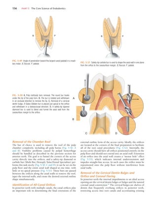 156	 PART I  The Core Science of Endodontics
FIG. 5-49  Angle of penetration toward the largest canal (palatal) in a maxil-
lary molar. B, Buccal; P, palatal.
B P
FIG. 5-50  A, Pulp roof/pulp horn removal. The round bur hooks
under the lip of the pulp horn. B, The bur is rotated and withdrawn
in an occlusal direction to remove the lip. C, Removal of a cervical
dentin bulge. A Gates-Glidden bur is placed just apical to the orifice
and withdrawn in a distoocclusal direction. D, A safety-tip tapered
diamond bur is used to blend and funnel the axial wall from the
cavosurface margin to the orifice.
A
B
C D
FIG. 5-51  Safety-tip carbide bur is used to shape the axial wall in one plane
from the orifice to the cavosurface margin. B, Buccal; P, palatal.
B P
Removal of the Chamber Roof
The bur of choice is used to remove the roof of the pulp
chamber completely, including all pulp horns (Fig. 5-50, A
and B). Visibility problems caused by pulpal hemorrhage
should be handled as described in the previous section for
anterior teeth. The goal is to funnel the corners of the access
cavity directly into the orifices, and a safety-tip diamond or
carbide bur (Multi Bur, Dentsply Tulsa Dental Specialties) per-
forms this task nicely (Fig. 5-50, C and D); it can be set on the
pulp floor and the entire axial wall shaped at one time, with
little or no apical pressure (Fig. 5-51). These burs are passed
between the orifices along the axial walls to remove the roof,
taper the internal walls, and create the desired external outline
shape simultaneously.
Identification of All Canal Orifices
In posterior teeth with multiple canals, the canal orifices play
an important role in determining the final extensions of the
external outline form of the access cavity. Ideally, the orifices
are located at the corners of the final preparation to facilitate
all of the root canal procedures (Fig. 5-52). Internally, the
access cavity should have all orifices positioned entirely on the
pulp floor and should not extend into an axial wall. Extension
of an orifice into the axial wall creates a “mouse hole” effect
(Fig. 5-53), which indicates internal underextension and
impedes straight-line access. In such cases the orifice must be
repositioned onto the pulp floor without interference from
axial walls.
Removal of the Cervical Dentin Bulges and
Orifice and Coronal Flaring
In posterior teeth the internal impediments to an ideal access
opening are the cervical dentin ledges or bulges and the natural
coronal canal constriction.84
The cervical bulges are shelves of
dentin that frequently overhang orifices in posterior teeth,
restricting access into root canals and accentuating existing
 
