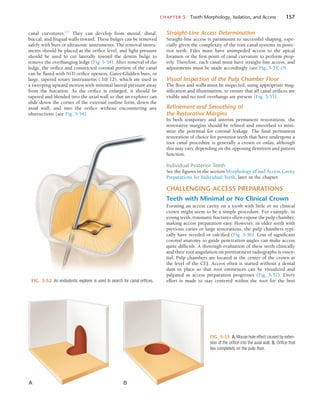 CHAPTER 5  Tooth Morphology, Isolation, and Access	 157
FIG. 5-52  An endodontic explorer is used to search for canal orifices.
FIG. 5-53  A, Mouse hole effect caused by exten-
sion of the orifice into the axial wall. B, Orifice that
lies completely on the pulp floor.
A B
canal curvatures.117
They can develop from mesial, distal,
buccal, and lingual walls inward. These bulges can be removed
safely with burs or ultrasonic instruments. The removal instru-
ments should be placed at the orifice level, and light pressure
should be used to cut laterally toward the dentin bulge to
remove the overhanging ledge (Fig. 5-54). After removal of the
ledge, the orifice and constricted coronal portion of the canal
can be flared with NiTi orifice openers, Gates-Glidden burs, or
large, tapered rotary instruments (.10/.12), which are used in
a sweeping upward motion with minimal lateral pressure away
from the furcation. As the orifice is enlarged, it should be
tapered and blended into the axial wall so that an explorer can
slide down the corner of the external outline form, down the
axial wall, and into the orifice without encountering any
obstructions (see Fig. 5-54).
Straight-Line Access Determination
Straight-line access is paramount to successful shaping, espe-
cially given the complexity of the root canal systems in poste-
rior teeth. Files must have unimpeded access to the apical
foramen or the first point of canal curvature to perform prop-
erly. Therefore, each canal must have straight-line access, and
adjustments must be made accordingly (see Fig. 5-54, O).
Visual Inspection of the Pulp Chamber Floor
The floor and walls must be inspected, using appropriate mag-
nification and illumination, to ensure that all canal orifices are
visible and no roof overhangs are present (Fig. 5-55).
Refinement and Smoothing of
the Restorative Margins
In both temporary and interim permanent restorations, the
restorative margins should be refined and smoothed to mini-
mize the potential for coronal leakage. The final permanent
restoration of choice for posterior teeth that have undergone a
root canal procedure is generally a crown or onlay, although
this may vary, depending on the opposing dentition and patient
function.
Individual Posterior Teeth
See the figures in the section Morphology of and Access Cavity
Preparations for Individual Teeth, later in the chapter.
CHALLENGING ACCESS PREPARATIONS
Teeth with Minimal or No Clinical Crown
Forming an access cavity on a tooth with little or no clinical
crown might seem to be a simple procedure. For example, in
young teeth, traumatic fractures often expose the pulp chamber,
making access preparation easy. However, in older teeth with
previous caries or large restorations, the pulp chambers typi-
cally have receded or calcified (Fig. 5-56). Loss of significant
coronal anatomy to guide penetration angles can make access
quite difficult. A thorough evaluation of these teeth clinically
and their root angulation on pretreatment radiographs is essen-
tial. Pulp chambers are located at the center of the crown at
the level of the CEJ. Access often is started without a dental
dam in place so that root eminences can be visualized and
palpated as access preparation progresses (Fig. 5-57). Every
effort is made to stay centered within the root for the best
 