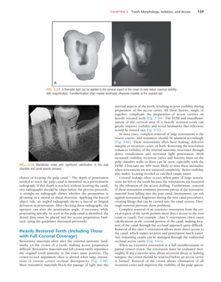 CHAPTER 5  Tooth Morphology, Isolation, and Access	 159
FIG. 5-55  A fiberoptic light can be applied to the cervical aspect of the crown to help obtain maximal visibility
with magnification. Transillumination often reveals landmarks otherwise invisible to the unaided eye.
A B
FIG. 5-56  Mandibular molar with significant calcification of the pulp
chamber and canal spaces (arrows).
chance of locating the pulp canal.25
The depth of penetration
needed to reach the pulp canal is measured on a pretreatment
radiograph. If this depth is reached without locating the canal,
two radiographs should be taken before the process proceeds.
A straight-on radiograph shows whether the preparation is
deviating in a mesial or distal direction. Applying the buccal
object rule, an angled radiograph shows a buccal or lingual
deviation in penetration. After checking these radiographs, the
operator can alter the penetration angle, if necessary, while
penetrating apically. As soon as the pulp canal is identified, the
dental dam must be placed and the access preparation final-
ized, using the guidelines discussed previously.
Heavily Restored Teeth (Including Those
with Full Coronal Coverage)
Restorative materials often alter the external anatomic land-
marks on the crown of a tooth, making access preparation
difficult. Restorative materials and full crowns rarely reproduce
the original tooth anatomy in the exact same position. The
crown-to-root angulation often is altered when large restora-
tions or crowns correct occlusal discrepancies (Fig. 5-58).
Most restorative materials block the passage of light into the
internal aspects of the tooth, resulting in poor visibility during
preparation of the access cavity. All these factors, singly or
together, complicate the preparation of access cavities on
heavily restored teeth (Fig. 5-59).1
The DOM and transillumi-
nation of the cervical area of a heavily restored tooth can
greatly improve visibility and reveal landmarks that otherwise
would be missed (see Fig. 5-55).
In most cases, complete removal of large restorations is the
wisest course, and treatment should be planned accordingly
(Fig. 5-60). These restorations often have leaking, defective
margins or recurrent caries, or both. Removing the restoration
enhances visibility of the internal anatomic structures through
direct visualization and increased light penetration. With
increased visibility, recurrent caries and fracture lines on the
pulp chamber walls or floor can be seen, especially with the
DOM. Clinicians are 40% more likely to miss these anomalies
when restorations are not removed completely.1
Better visibility
also makes locating receded or calcified canals easier.
Coronal leakage often occurs when parts of large restora-
tions are left in the tooth because the restorations are loosened
by the vibration of the access drilling. Furthermore, removal
of these restoration remnants prevents pieces of the restorative
material from falling into the root canal. Instruments can rub
against restoration fragments during the root canal procedures,
creating filings that can be carried into the canal system. Thor-
ough removal prevents these problems.
Complete removal of an extensive restoration from the cer-
vical region of the tooth permits more direct access to the root
canal or canals. For example, class V restorations often cause
calcifications in the coronal portion of the canal, making loca-
tion of the canal through the occlusal approach quite difficult.
Removal of the class V restoration allows more direct access to
the canal, which makes location and penetration much easier.
Any remaining canals can be managed through the traditional
occlusal access cavity (Fig. 5-61).
When an extensive restoration is a full metalloceramic or
partial veneer crown, the restoration must be evaluated thor-
oughly. If any concerns arise about recurrent decay or leaking
margins, the crown should be removed before an access cavity
is formed. Removal of the crown allows elimination of all
recurrent caries and improves the visibility of the pulp spaces.
 