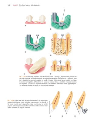 160	 PART I  The Core Science of Endodontics
FIG. 5-57  Access cavity preparation when the anatomic crown is missing. A, Mandibular first premolar with
the crown missing. B, An endodontic explorer fails to penetrate the calcified pulp chamber. C, A long-shank round
bur is directed in the assumed long axis of the root. D, Perforation of the root wall (arrow), resulting from failure
to consider root angulation. E, Palpation of the buccal root anatomy without a dental dam in place to determine
root angulation. F, Correct bur angulation after repair of the perforation with mineral trioxide aggregate (MTA).
The dental dam is placed as soon as the canal has been identified.
A
C
D
E
B
F
FIG. 5-58  Access cavity error resulting from alteration of the original tooth
contours by a full veneer crown. A, Original crown contour of the tooth. B, A
full veneer crown is used to change the original crown contour for esthetic
purposes. C, Access perforation resulting from reliance on the full veneer crown
contour rather than the long axis of the root.
A C
B
 