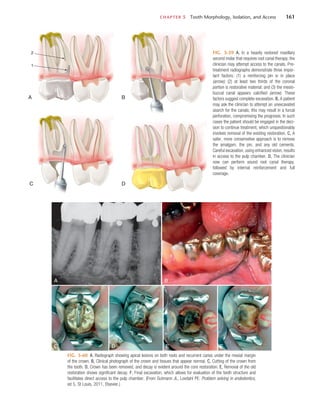 CHAPTER 5  Tooth Morphology, Isolation, and Access	 161
FIG. 5-59  A, In a heavily restored maxillary
second molar that requires root canal therapy, the
clinician may attempt access to the canals. Pre-
treatment radiographs demonstrate three impor-
tant factors: (1) a reinforcing pin is in place
(arrow); (2) at least two thirds of the coronal
portion is restorative material; and (3) the mesio-
buccal canal appears calcified (arrow). These
factors suggest complete excavation. B, A patient
may ask the clinician to attempt an unexcavated
search for the canals; this may result in a furcal
perforation, compromising the prognosis. In such
cases the patient should be engaged in the deci-
sion to continue treatment, which unquestionably
involves removal of the existing restoration. C, A
safer, more conservative approach is to remove
the amalgam, the pin, and any old cements.
Careful excavation, using enhanced vision, results
in access to the pulp chamber. D, The clinician
now can perform sound root canal therapy, 
followed by internal reinforcement and full
coverage.
A
1
2
B
C D
FIG. 5-60  A, Radiograph showing apical lesions on both roots and recurrent caries under the mesial margin
of the crown. B, Clinical photograph of the crown and tissues that appear normal. C, Cutting of the crown from
the tooth. D, Crown has been removed, and decay is evident around the core restoration. E, Removal of the old
restoration shows significant decay. F, Final excavation, which allows for evaluation of the tooth structure and
facilitates direct access to the pulp chamber. (From Gutmann JL, Lovdahl PE: Problem solving in endodontics,
ed 5, St Louis, 2011, Elsevier.)
A
C D E F
B
 