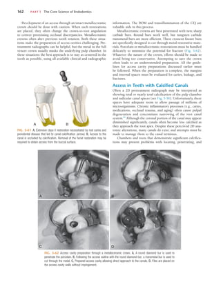162	 PART I  The Core Science of Endodontics
Development of an access through an intact metalloceramic
crown should be done with caution. When such restorations
are placed, they often change the crown-to-root angulation
to correct preexisting occlusal discrepancies. Metalloceramic
crowns often alter previous tooth rotation. Both these situa-
tions make the preparation of access cavities challenging. Pre-
treatment radiographs can be helpful, but the metal in the full
veneer crown usually masks the underlying pulp chamber. In
these situations the best approach is to stay as centered in the
tooth as possible, using all available clinical and radiographic
FIG. 5-61  A, Extensive class V restoration necessitated by root caries and
periodontal disease that led to canal calcification (arrow). B, Access to the
canal is occluded by calcification. Removal of the facial restoration may be
required to obtain access from the buccal surface.
A B
FIG. 5-62  Access cavity preparation through a metalloceramic crown. A, A round diamond bur is used to
penetrate the porcelain. B, Following the access outline with the round diamond bur, a transmetal bur is used to
cut through the metal. C, Prepared access cavity allowing direct approach to the canals. D, Files are placed on
the access cavity walls without impingement.
A B
D
C
information. The DOM and transillumination of the CEJ are
valuable aids in this process.
Metalloceramic crowns are best penetrated with new, sharp
carbide burs. Round burs work well, but tungsten carbide
transmetal burs are more efficient. These crosscut fissure burs
are specifically designed to cut through metal restorative mate-
rials. Porcelain or metalloceramic restorations must be handled
delicately to minimize the potential for fracture (Fig. 5-62).
Whatever the nature of the crown, efforts should be made to
avoid being too conservative. Attempting to save the crown
often leads to an underextended preparation. All the guide-
lines for access cavity preparations discussed earlier must
be followed. When the preparation is complete, the margins
and internal spaces must be evaluated for caries, leakage, and
fractures.
Access in Teeth with Calcified Canals
Often a 2D pretreatment radiograph may be interpreted as
showing total or nearly total calcification of the pulp chamber
and radicular canal spaces (see Fig. 5-56). Unfortunately, these
spaces have adequate room to allow passage of millions of
microorganisms. Chronic inflammatory processes (e.g., caries,
medications, occlusal trauma, and aging) often cause pulpal
degeneration and concomitant narrowing of the root canal
system.84
Although the coronal portion of the canal may appear
diminished significantly, canals often become less calcified as
they approach the root apex. Despite these perceived 2D ana-
tomic alterations, many canals do exist, and attempts must be
made to manage them to the canal terminus.
Chambers and roots that demonstrate significant calcifica-
tions may present problems with locating, penetrating, and
 
