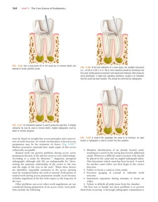 164	 PART I  The Core Science of Endodontics
must be based on straight-line access principles and conserva-
tion of tooth structure. In certain circumstances a buccal access
preparation may be the treatment of choice (Fig. 5-70).84
Modern restorative materials have made repair of this access
esthetically acceptable.
Rotated teeth can present problems during access cavity
preparation because of the altered crown-to-root relationships.
According to a study by Moreinis,144
diagnostic periapical
radiographs, although only 2D, are indispensable for “deter-
mining the anatomic relationship of the crown to the root
and the angle of the root in the arch.” When these factors
are identified, reasonable variations in the access opening
must be visualized before the tooth is entered. Perforations in
rotated teeth during access preparation usually occur because
of faulty angulation of the bur with respect to the long axis of
the root.
Other problems can occur when tooth angulations are not
considered during preparation of an access cavity. Such prob-
lems include the following:
FIG. 5-66  Use a long-shank #2 or #4 round bur to remove dentin and
attempt to locate calcified canals.
FIG. 5-67  An endodontic explorer is used to probe the pulp floor. A straight
ultrasonic tip may be used to remove dentin. Angled radiographs must be
taken to monitor progress.
FIG. 5-68  At the first indication of a canal space, the smallest instrument
(i.e., a #.06 or #.08 C or C+ file or micro openers) should be introduced into
the canal. Gentle passive movement, both apical and rotational, often produces
some penetration. A slight pull, signaling resistance, usually is an indication
that the canal has been located. This should be confirmed by radiographs.
FIG. 5-69  A small K-file negotiates the canal to its terminus. An apex
locator or radiograph is used to confirm the file’s position.
•	 Mistaken identification of an already located canal,
resulting in a search in the wrong direction for additional
canals. Whenever a difficult canal is located, a file should
be placed in the canal and an angled radiograph taken.
This determines which canal has been located. A search
for another canal orifice can then begin in the correct
direction.
•	 Failure to locate a canal or extra canals.
•	 Excessive gouging of coronal or radicular tooth
structure.
•	 Instrument separation during attempts to locate an
orifice.
•	 Failure to débride all pulp tissue from the chamber.
The best way to handle any these problems is to prevent
them from occurring. A thorough radiographic examination is
 
