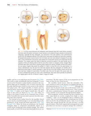 166	 PART I  The Core Science of Endodontics
FIG. 5-71  A, Poor access placement and inadequate mesial extension leave both mesial orifices uncovered.
Information about the position and location of pulp chambers can be obtained through evaluation of pretreatment
radiographs, especially bite-wing radiographs, and assessment of the tooth anatomy at the cementoenamel
junction (CEJ). B, Inadequate extension of the distal access cavity leaves the distobuccal canal orifice unexposed.
All developmental grooves must be traced to their termination and must not be allowed to disappear into an axial
wall. C, Gross overextension of the access cavity weakens the coronal tooth structure and compromises the final
restoration. This mistake results from failure to determine correctly the position of the pulp chamber and the
angulation of the bur. D, Allowing debris to fall into canal orifices results in an iatrogenic mishap. Amalgam fillings
and dentin debris block canal orifices, preventing proper shaping and cleaning. Complete removal of the restora-
tion and copious irrigation help prevent this problem. E, Failure to remove the roof of the pulp chamber is a
serious underextension error; the pulp horns have been exposed. Bite-wing radiographs are excellent aids in
determining vertical depth. F, Access preparation in which the roof of the pulp chamber remains and the pulp
horns have been mistaken for canal orifices. The whitish color of the roof, the depth of the access cavity, and
the lack of developmental grooves are clues to this underextension. Root canal orifices generally are positioned
at or slightly apical to the CEJ. B, Buccal; D, distal; L, lingual; M, mesial.
L
B
D
M
A B L
B
D
M
L
B
D
M
C
D E
F
smaller, and two or no pulp horns may be present (Fig. 5-80).
This tooth is wider mesiodistally than buccolingually. A cross
section at the CEJ shows a pulp chamber centered in the root,
and its shape may be triangular, oval, or round. From the CEJ
the pulp canal becomes round in cross section in the midroot
and apical areas. The lingual shoulder of dentin must be
removed before instruments can be used to explore the canal
(see Table 5-9 online at the Expert Consult site). The µCT
scans of this tooth are shown in Fig. 5-81. (See Video 5-2
online at the Expert Consult site for rotational views of these
teeth.) Normally only one root canal is present, but other varia-
tions have been reported.
The external access outline form for the maxillary lateral
incisor may be a rounded triangle or an oval, depending on the
prominence of the mesial and distal pulp horns (Figs. 5-82
through 5-84). When the horns are prominent, the rounded
triangular shape is compressed mesiodistally relative to a
central incisor, producing a more slender triangle. The outline
form usually is oval if the mesial and distal pulp horns are not
prominent. All other aspects of the access preparation are the
same as those for the central incisor.
The maxillary lateral incisor often has anomalies. One
such variation in form is the presence of a palatal radicular or
developmental groove (Fig. 5-85).121,153-155,161-164
Although this
groove may be present on the roots of all anterior teeth, it is
more common in the maxillary lateral incisor. There is gener-
ally direct communication between the groove and the pulp
cavity, and this occurs primarily through dentinal tubules.
Dens invaginatus, another anomaly, has been classified into
three types based on severity, ranging from simple to more
complex.194
Type 1 is an invagination that is confined to the
crown. Type 2 is an invagination that extends past the CEJ but
does not involve the periradicular tissues. Type 3 is an invagi-
nation that extends beyond the CEJ and can have a second
apical foramen. Often both surgical and nonsurgical root canal
procedures are necessary to properly manage this condition.*
*References 155, 167, 170, 178, 179, 181, 182, 188, 195, and 208.
 