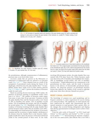 CHAPTER 5  Tooth Morphology, Isolation, and Access	 133
the periodontium, although communication of inflammatory
processes may occur from either tissue.
Accessory canals that are present in the bifurcation or
trifurcation of multirooted teeth are referred to as furcation
canals (Fig. 5-6).223,226
These channels form as a result of the
entrapment of periodontal vessels during the fusion of the
diaphragm, which becomes the pulp chamber floor.46
In man-
dibular molars these canals occur in three distinct patterns
(Fig. 5-7). Tables 5-1 and 5-2 present the incidence of furcation
canals for each tooth.
Based on scanning electron microscopy (SEM) studies, the
diameter of furcation openings in mandibular molars varies
from 4 to 720 m.224
The number of furcation canals ranges
from none to more than 20 per specimen. Foramina on both
the pulp chamber floor and the furcation surface were found
in 36% of maxillary first molars, 12% of maxillary second
molars, 32% of mandibular first molars, and 24% of mandibu-
lar second molars (Fig. 5-8). Mandibular teeth have a higher
incidence of foramina involving both the pulp chamber floor
and the furcation surface (56%) than do maxillary teeth (48%).
No relationship was found between the incidence of accessory
foramina and the occurrence of pulp chamber calcification or
the distance from the chamber floor to the furcation. Radio-
graphs usually fail to show the presence of furcation and lateral
canals in the coronal portion of these roots. In one study
FIG. 5-6  Mandibular first molar showing a furcation canal (FC, arrows).
F, Furcation; PC, pulp chamber floor; RC, root canal.
FC
F
PC
RC
RC
FIG. 5-7  Accessory canals occur in three distinct patterns in the mandibular
first molars. A, In 13% a single furcation canal extends from the pulp chamber
to the intraradicular region. B, In 23% a lateral canal extends from the coronal
third of a major root canal to the furcation region (80% extend from the distal
root canal). C, About 10% have both lateral and furcation canals.
A B C
FIG. 5-5  A, Formation of reparative dentin and reduction of the pulp chamber space. B, Calcific narrowing and
closing of a root canal as it leaves the pulp chamber. (From Gutmann JL, Lovdahl PE: Problem solving in end-
odontics, ed 5, St Louis, 2011, Elsevier.)
A B
involving 200 permanent molars, the pulp chamber floor was
stained with 0.5% basic fuscin dye. Patent furcation canals
were detected in 24% of maxillary and mandibular first molars,
20% of mandibular second molars, and 16% of maxillary
second molars.87
Pulpal inflammation can communicate to the
periodontium via these canals, and the result is furcation
lesions in the absence of demonstrable periodontal disease.
Likewise, the long-term presence of periodontal furcation
lesions may influence the viability of the coronal or radicular
pulp tissue when these aberrant channels are present.84
ROOT CANAL ANATOMY
The knowledge of common root canal morphology and its
frequent variations is a basic requirement for success during
root canal procedures. The significance of canal anatomy has
been underscored by studies that demonstrated that the
natural variations in canal geometry had a greater effect on
the changes that occurred during enlargement and shaping
than did the instrumentation techniques used to achieve these
objectives.167-169
From the early works of Preiswerk175
in 1912, Fasoli and
Arlotta67
in 1913, and Hess and Zurcher90
in 1917, to more
recent studies33,82,100,190
demonstrating the anatomic complexi-
ties of the root canal system, data indicate that a root with a
 