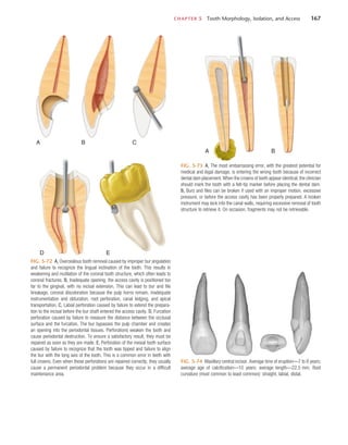 CHAPTER 5  Tooth Morphology, Isolation, and Access	 167
FIG. 5-72  A, Overzealous tooth removal caused by improper bur angulation
and failure to recognize the lingual inclination of the tooth. This results in
weakening and mutilation of the coronal tooth structure, which often leads to
coronal fractures. B, Inadequate opening; the access cavity is positioned too
far to the gingival, with no incisal extension. This can lead to bur and file
breakage, coronal discoloration because the pulp horns remain, inadequate
instrumentation and obturation, root perforation, canal ledging, and apical
transportation. C, Labial perforation caused by failure to extend the prepara-
tion to the incisal before the bur shaft entered the access cavity. D, Furcation
perforation caused by failure to measure the distance between the occlusal
surface and the furcation. The bur bypasses the pulp chamber and creates
an opening into the periodontal tissues. Perforations weaken the tooth and
cause periodontal destruction. To ensure a satisfactory result, they must be
repaired as soon as they are made. E, Perforation of the mesial tooth surface
caused by failure to recognize that the tooth was tipped and failure to align
the bur with the long axis of the tooth. This is a common error in teeth with
full crowns. Even when these perforations are repaired correctly, they usually
cause a permanent periodontal problem because they occur in a difficult
maintenance area.
A B C
D E
FIG. 5-73  A, The most embarrassing error, with the greatest potential for
medical and legal damage, is entering the wrong tooth because of incorrect
dental dam placement. When the crowns of teeth appear identical, the clinician
should mark the tooth with a felt-tip marker before placing the dental dam. 
B, Burs and files can be broken if used with an improper motion, excessive
pressure, or before the access cavity has been properly prepared. A broken
instrument may lock into the canal walls, requiring excessive removal of tooth
structure to retrieve it. On occasion, fragments may not be retrievable.
A B
FIG. 5-74  Maxillary central incisor. Average time of eruption—7 to 8 years;
average age of calcification—10 years; average length—22.5 mm. Root
curvature (most common to least common): straight, labial, distal.
 
