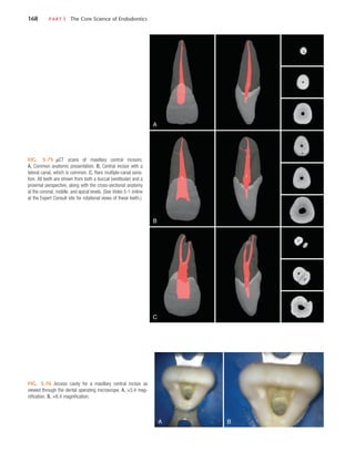 168	 PART I  The Core Science of Endodontics
FIG. 5-75  µCT scans of maxillary central incisors.
A, Common anatomic presentation. B, Central incisor with a
lateral canal, which is common. C, Rare multiple-canal varia-
tion. All teeth are shown from both a buccal (vestibular) and a
proximal perspective, along with the cross-sectional anatomy
at the coronal, middle, and apical levels. (See Video 5-1 online
at the Expert Consult site for rotational views of these teeth.)
A
B
C
FIG. 5-76  Access cavity for a maxillary central incisor as
viewed through the dental operating microscope. A, ×3.4 mag-
nification. B, ×8.4 magnification.
A B
 