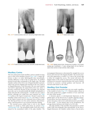 CHAPTER 5  Tooth Morphology, Isolation, and Access	 169
FIG. 5-77  Curved accessory canal with intersecting straight lateral canal.
FIG. 5-78  Parallel accessory canal to main canal with a simple lateral canal.
FIG. 5-79  Double lateral canals.
FIG. 5-80  Maxillary lateral incisor. Average time of eruption—8 to 9 years;
average age of calcification—11 years; average length—22 mm. Root cur-
vature (most common to least common): distal, straight.
Maxillary Canine
The root canal system of the maxillary canine is similar in many
ways to that of the maxillary incisors (Fig. 5-86). A major dif-
ference is that it is wider labiolingually than mesiodistally.
Another difference is that it has no pulp horns. Its smallest
pointed incisal edge corresponds to the single cusp. The pulp
chamber outline at the CEJ is oval. A lingual shoulder is present,
which may prevent shaping and cleaning of the root canal in
its lingual dimension. From this point, the root canal remains
oval until it approaches the apical third of the root, where it
becomes constricted. Because of this oval shape, the clinician
must take care to circumferentially file labially and palatally to
shape and clean the canal properly.124
Usually one root canal is
present, although two canals have been reported (see Table
5-10 online at the Expert Consult site). The µCT scans for the
maxillary canine can be seen in Fig. 5-87. (See Video 5-3 online
at the Expert Consult site) for rotational views of these teeth.
The thin buccal bone over the canine eminence often disinte-
grates, and fenestration is an occasional anatomic finding.
The external access outline form is oval or slot shaped
because no mesial or distal pulp horns are present (Figs.
5-88 through 5-90). The mesiodistal width of the slot is deter-
mined by the mesiodistal width of the pulp chamber. The
incisogingival dimension is determined by straight-line access
factors and removal of the lingual shoulder. The incisal exten-
sion often approaches to within 2 to 3 mm of the incisal edge
to allow for straight-line access. The incisal wall meets the
lingual surface of the canine in a butt joint to provide adequate
thickness for restorative material because this tooth is heavily
involved in excursive occlusal guidance and function. All
internal walls funnel to the orifice.
Maxillary First Premolar
Most maxillary first premolars have two root canals, regardless
of the number of roots (Fig. 5-91). Ethnicity plays a factor in
that Asian people have a higher incidence of one canal than
do other ethnic groups.120,156
A furcation groove or developmental depression on the
palatal aspect of the buccal root is another anatomic feature.
Its prevalence has been reported as 62% to 100%.97,112,211
This
groove may pose a risk to root canal and restorative procedures
in this tooth.118
At the deepest part of the invagination, the
average dentin thickness was found to be 0.81 mm.
The pulp chamber of the maxillary first premolar is consid-
erably wider buccolingually than mesiodistally. In the bucco-
lingual dimension, the chamber outline shows a buccal and a
 