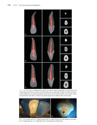 170	 PART I  The Core Science of Endodontics
FIG. 5-81  µCT scans of maxillary lateral incisors. A, Common anatomic presentation. B, Lateral incisor with
a large lateral canal, which is common. C, Lateral incisor with an apical delta. All teeth are shown from both a
buccal (vestibular) and a proximal perspective, along with the cross-sectional anatomy at the coronal, middle,
and apical levels. (See Video 5-2 online at the Expert Consult site for rotational views of these teeth.)
A
B
C
FIG. 5-82  Access cavity for a maxillary lateral incisor as viewed through the dental operating microscope.
A, ×3.4 magnification. B, ×5.1 magnification with cervical fiberoptic transillumination.
A B
 