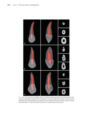 172	 PART I  The Core Science of Endodontics
FIG. 5-87  µCT scans for the maxillary canine. A, Common anatomic presentation. B, Canine with two roots.
C, Canine with significant deviations of the canal system in the apical thirdAll teeth are shown from both a buccal
(vestibular) and a proximal perspective, along with the cross-sectional anatomy at the coronal, middle, and apical
levels. (See Video 5-3 online at the Expert Consult site for rotational views of these teeth.)
A
B
C
 