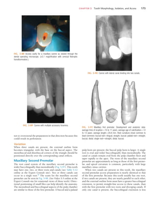 CHAPTER 5  Tooth Morphology, Isolation, and Access	 173
FIG. 5-88  Access cavity for a maxillary canine as viewed through the
dental operating microscope. (×5.1 magnification with cervical fiberoptic
transillumination.)
FIG. 5-89  Canine with multiple accessory foramina.
FIG. 5-90  Canine with lateral canal dividing into two canals.
FIG. 5-91  Maxillary first premolar. Development and anatomic data:
average time of eruption—10 to 11 years; average age of calcification—12
to 13 years; average length—20.6 mm. Root curvature (most common to
least common): buccal root—lingual, straight, buccal; palatal root—straight,
buccal, distal; single root—straight, distal, buccal.
not to overextend the preparation in that direction because this
could result in perforation.
Variation
When three canals are present, the external outline form
becomes triangular, with the base on the buccal aspect. The
mesiobuccal and distobuccal corners of the triangle should be
positioned directly over the corresponding canal orifices.
Maxillary Second Premolar
The root canal system of the maxillary second premolar is
wider buccolingually than mesiodistally (Fig. 5-97). This tooth
may have one, two, or three roots and canals (see Table 5-12
online at the Expert Consult site). Two or three canals can
occur in a single root.68
The scans for the maxillary second
premolar can be seen in Fig. 5-98. (See Video 5-5 online at the
Expert Consult site for rotational views of these teeth.) Direc-
tional positioning of small files can help identify the anatomy.
The mesiodistal and buccolingual aspects of the pulp chamber
are similar to those of the first premolar. A buccal and a palatal
pulp horn are present; the buccal pulp horn is larger. A single
root is oval and wider buccolingually than mesiodistally. The
canal or canals remain oval from the pulp chamber floor and
taper rapidly to the apex. The roots of the maxillary second
premolar are approximately as long as those of the first premo-
lar, and apical curvature is common, particularly with large
maxillary sinus cavities.
When two canals are present in this tooth, the maxillary
second premolar access preparation is nearly identical to that
of the first premolar. Because this tooth usually has one root,
if two canals are present, they are nearly parallel to each other,
and the external outline form must have a greater buccolingual
extension, to permit straight-line access to these canals, than
with the first premolar with two roots and diverging canals. If
only one canal is present, the buccolingual extension is less
 