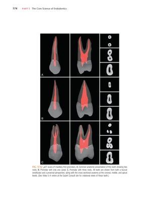 174	 PART I  The Core Science of Endodontics
FIG. 5-92  µCT scans of maxillary first premolars. A, Common anatomic presentation of this tooth showing two
roots. B, Premolar with only one canal. C, Premolar with three roots. All teeth are shown from both a buccal
(vestibular) and a proximal perspective, along with the cross-sectional anatomy at the coronal, middle, and apical
levels. (See Video 5-4 online at the Expert Consult site for rotational views of these teeth.)
A
B
C
 