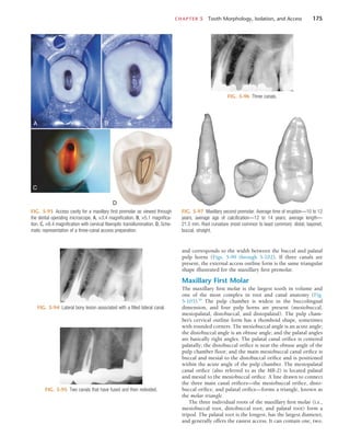 CHAPTER 5  Tooth Morphology, Isolation, and Access	 175
and corresponds to the width between the buccal and palatal
pulp horns (Figs. 5-99 through 5-102). If three canals are
present, the external access outline form is the same triangular
shape illustrated for the maxillary first premolar.
Maxillary First Molar
The maxillary first molar is the largest tooth in volume and
one of the most complex in root and canal anatomy (Fig.
5-103).50
The pulp chamber is widest in the buccolingual
dimension, and four pulp horns are present (mesiobuccal,
mesiopalatal, distobuccal, and distopalatal). The pulp cham-
ber’s cervical outline form has a rhomboid shape, sometimes
with rounded corners. The mesiobuccal angle is an acute angle;
the distobuccal angle is an obtuse angle; and the palatal angles
are basically right angles. The palatal canal orifice is centered
palatally; the distobuccal orifice is near the obtuse angle of the
pulp chamber floor; and the main mesiobuccal canal orifice is
buccal and mesial to the distobuccal orifice and is positioned
within the acute angle of the pulp chamber. The mesiopalatal
canal orifice (also referred to as the MB-2) is located palatal
and mesial to the mesiobuccal orifice. A line drawn to connect
the three main canal orifices—the mesiobuccal orifice, disto-
buccal orifice, and palatal orifice—forms a triangle, known as
the molar triangle.
The three individual roots of the maxillary first molar (i.e.,
mesiobuccal root, distobuccal root, and palatal root) form a
tripod. The palatal root is the longest, has the largest diameter,
and generally offers the easiest access. It can contain one, two,
FIG. 5-93  Access cavity for a maxillary first premolar as viewed through
the dental operating microscope. A, ×3.4 magnification. B, ×5.1 magnifica-
tion. C, ×8.4 magnification with cervical fiberoptic transillumination. D, Sche-
matic representation of a three-canal access preparation.
D
A B
C
FIG. 5-94  Lateral bony lesion associated with a filled lateral canal.
FIG. 5-95  Two canals that have fused and then redivided.
FIG. 5-96  Three canals.
FIG. 5-97  Maxillary second premolar. Average time of eruption—10 to 12
years; average age of calcification—12 to 14 years; average length—
21.5 mm. Root curvature (most common to least common): distal, bayonet,
buccal, straight.
 