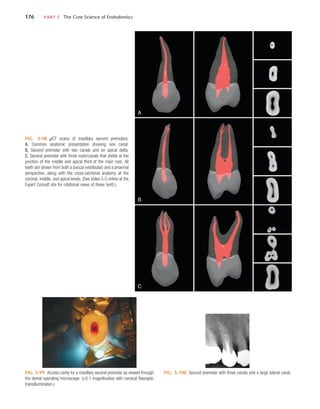 176	 PART I  The Core Science of Endodontics
FIG. 5-98  µCT scans of maxillary second premolars.
A, Common anatomic presentation showing one canal.
B, Second premolar with two canals and an apical delta.
C, Second premolar with three roots/canals that divide at the
junction of the middle and apical third of the main root. All
teeth are shown from both a buccal (vestibular) and a proximal
perspective, along with the cross-sectional anatomy at the
coronal, middle, and apical levels. (See Video 5-5 online at the
Expert Consult site for rotational views of these teeth.)
A
B
C
FIG. 5-99  Access cavity for a maxillary second premolar as viewed through
the dental operating microscope. (×5.1 magnification with cervical fiberoptic
transillumination.)
FIG. 5-100  Second premolar with three canals and a large lateral canal.
 