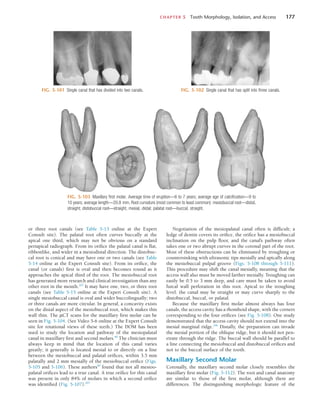 CHAPTER 5  Tooth Morphology, Isolation, and Access	 177
FIG. 5-101  Single canal that has divided into two canals. FIG. 5-102  Single canal that has split into three canals.
FIG. 5-103  Maxillary first molar. Average time of eruption—6 to 7 years; average age of calcification—9 to
10 years; average length—20.8 mm. Root curvature (most common to least common): mesiobuccal root—distal,
straight; distobuccal root—straight, mesial, distal; palatal root—buccal, straight.
or three root canals (see Table 5-13 online at the Expert
Consult site). The palatal root often curves buccally at the
apical one third, which may not be obvious on a standard
periapical radiograph. From its orifice the palatal canal is flat,
ribbonlike, and wider in a mesiodistal direction. The distobuc-
cal root is conical and may have one or two canals (see Table
5-14 online at the Expert Consult site). From its orifice, the
canal (or canals) first is oval and then becomes round as it
approaches the apical third of the root. The mesiobuccal root
has generated more research and clinical investigation than any
other root in the mouth.202
It may have one, two, or three root
canals (see Table 5-15 online at the Expert Consult site). A
single mesiobuccal canal is oval and wider buccolingually; two
or three canals are more circular. In general, a concavity exists
on the distal aspect of the mesiobuccal root, which makes this
wall thin. The µCT scans for the maxillary first molar can be
seen in Fig. 5-104. (See Video 5-6 online at the Expert Consult
site for rotational views of these teeth.) The DOM has been
used to study the location and pathway of the mesiopalatal
canal in maxillary first and second molars.80
The clinician must
always keep in mind that the location of this canal varies
greatly; it generally is located mesial to or directly on a line
between the mesiobuccal and palatal orifices, within 3.5 mm
palatally and 2 mm mesially of the mesiobuccal orifice (Figs.
5-105 and 5-106). These authors80
found that not all mesioo-
palatal orifices lead to a true canal. A true orifice for this canal
was present in only 84% of molars in which a second orifice
was identified (Fig. 5-107).205
Negotiation of the mesiopalatal canal often is difficult; a
ledge of dentin covers its orifice, the orifice has a mesiobuccal
inclination on the pulp floor, and the canal’s pathway often
takes one or two abrupt curves in the coronal part of the root.
Most of these obstructions can be eliminated by troughing or
countersinking with ultrasonic tips mesially and apically along
the mesiobuccal pulpal groove (Figs. 5-108 through 5-111).
This procedure may shift the canal mesially, meaning that the
access wall also must be moved farther mesially. Troughing can
easily be 0.5 to 3 mm deep, and care must be taken to avoid
furcal wall perforation in this root. Apical to the troughing
level. the canal may be straight or may curve sharply to the
distobuccal, buccal, or palatal.
Because the maxillary first molar almost always has four
canals, the access cavity has a rhomboid shape, with the corners
corresponding to the four orifices (see Fig. 5-108). One study
demonstrated that the access cavity should not extend into the
mesial marginal ridge.246
Distally, the preparation can invade
the mesial portion of the oblique ridge, but it should not pen-
etrate through the ridge. The buccal wall should be parallel to
a line connecting the mesiobuccal and distobuccal orifices and
not to the buccal surface of the tooth.
Maxillary Second Molar
Coronally, the maxillary second molar closely resembles the
maxillary first molar (Fig. 5-112). The root and canal anatomy
are similar to those of the first molar, although there are
differences. The distinguishing morphologic feature of the
 
