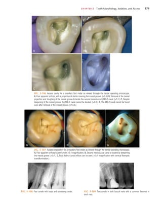 CHAPTER 5  Tooth Morphology, Isolation, and Access	 179
FIG. 5-106  Access cavity for a maxillary first molar as viewed through the dental operating microscope.
A, Four apparent orifices, with a projection of dentin covering the mesial groove. (×3.4.) B, Removal of the mesial
projection and troughing of the mesial groove to locate the second mesiobuccal (MB-2) canal. (×5.1.) C, Despite
deepening of the mesial groove, the MB-2 canal cannot be located. (×8.5.) D, The MB-2 canal cannot be found
even after removal of the mesial groove. (×13.6.)
A
C D
B
FIG. 5-107  Access preparation for a maxillary first molar as viewed through the dental operating microscope.
A, Four apparent orifices located under ×3.4 magnification. B, Second mesiobuccal canal is located by deepening
the mesial groove. (×5.1.) C, Four distinct canal orifices can be seen. (×5.1 magnification with cervical fiberoptic
transillumination.)
A B C
FIG. 5-108  Four canals with loops and accessory canals. FIG. 5-109  Two canals in both buccal roots with a common foramen in
each root.
 