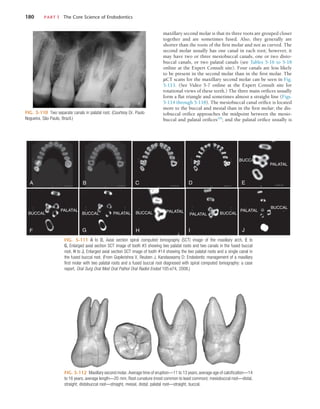 180	 PART I  The Core Science of Endodontics
FIG. 5-110  Two separate canals in palatal root. (Courtesy Dr. Paulo
Nogueira, São Paulo, Brazil.)
FIG. 5-111  A to D, Axial section spiral computed tomography (SCT) image of the maxillary arch. E to
G, Enlarged axial section SCT image of tooth #3 showing two palatal roots and two canals in the fused buccal
root. H to J, Enlarged axial section SCT image of tooth #14 showing the two palatal roots and a single canal in
the fused buccal root. (From Gopikrishna V, Reuben J, Kandaswamy D: Endodontic management of a maxillary
first molar with two palatal roots and a fused buccal root diagnosed with spiral computed tomography: a case
report, Oral Surg Oral Med Oral Pathol Oral Radiol Endod 105:e74, 2008.)
A B C
J
PALATAL
BUCCAL
I
PALATAL BUCCAL
F
PALATAL
BUCCAL
D E
PALATAL
BUCCAL
H
PALATAL
BUCCAL
G
PALATAL
BUCCAL
FIG. 5-112  Maxillary second molar. Average time of eruption—11 to 13 years; average age of calcification—14
to 16 years; average length—20 mm. Root curvature (most common to least common): mesiobuccal root—distal,
straight; distobuccal root—straight, mesial, distal; palatal root—straight, buccal.
maxillary second molar is that its three roots are grouped closer
together and are sometimes fused. Also, they generally are
shorter than the roots of the first molar and not as curved. The
second molar usually has one canal in each root; however, it
may have two or three mesiobuccal canals, one or two disto-
buccal canals, or two palatal canals (see Tables 5-16 to 5-18
online at the Expert Consult site). Four canals are less likely
to be present in the second molar than in the first molar. The
µCT scans for the maxillary second molar can be seen in Fig.
5-113. (See Video 5-7 online at the Expert Consult site for
rotational views of these teeth.) The three main orifices usually
form a flat triangle and sometimes almost a straight line (Figs.
5-114 through 5-118). The mesiobuccal canal orifice is located
more to the buccal and mesial than in the first molar; the dis-
tobuccal orifice approaches the midpoint between the mesio-
buccal and palatal orifices250
; and the palatal orifice usually is
 