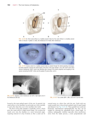 182	 PART I  The Core Science of Endodontics
FIG. 5-114  A, Three canal orifices in a maxillary second molar. B, Two canal orifices in a maxillary second
molar. B, Buccal; P, palatal; D, distal, DB, distobuccal; M, medial; MB, mesiobuccal.
A
B
D
MB
DB
M
P
P B
B
P
B
D M
P
FIG. 5-115  Access cavity for a maxillary second molar as viewed through the dental operating microscope.
A, Dentin projection covering the mesial aspect of the floor of the pulp chamber. (×8.4.) B, Fourth canal orifice
(second mesiobuccal, MB-2), which was identified after removal of the dentin projection and troughing of the
groove connecting the MB-1 orifice and the palatal (P) canal orifice. (×8.4.)
A B
FIG. 5-116  Severely curved mesiobuccal root with a right-angle curve in
the distobuccal (DB) root. FIG. 5-117  Four canals (MB-1, MB-2, DB, and P ) can be seen.
located at the most palatal aspect of the root. In general, the
canal orifices in the maxillary second molar are closer mesially
to each other than they are in the maxillary first molar.
The floor of the pulp chamber is markedly convex, which
gives the canal orifices a slight funnel shape. On occasion the
canals curve into the chamber at a more horizontal angle,
requiring removal of a lip of dentin so that a canal can be
entered more in a direct line with the axis. Teeth with two
canals usually have a buccal and a palatal canal of equal length
and diameter (see Fig. 5-114, B). These parallel root canals are
frequently superimposed radiographically, but they can be
imaged by exposing the radiograph from a distal angle. To
enhance radiographic visibility, especially when interference
arises from the malar process, a more perpendicular and
 