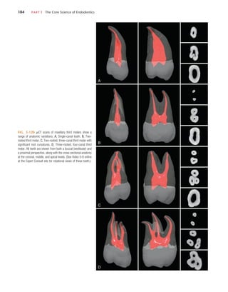 184	 PART I  The Core Science of Endodontics
FIG. 5-120  µCT scans of maxillary third molars show a
range of anatomic variations; A, Single-canal tooth. B, Two-
rooted third molar. C, Two-rooted, three-canal third molar with
significant root curvatures. D, Three-rooted, four-canal third
molar. All teeth are shown from both a buccal (vestibular) and
a proximal perspective, along with the cross-sectional anatomy
at the coronal, middle, and apical levels. (See Video 5-8 online
at the Expert Consult site for rotational views of these teeth.)
A
B
C
D
 
