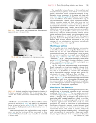 CHAPTER 5  Tooth Morphology, Isolation, and Access	 185
FIG. 5-121  Canals that have fused into a single canal. Multiple accessory
canals can be seen in the second molar.
FIG. 5-122  Distal bridge abutment with major accessory canal.
FIG. 5-123  Mandibular central/lateral incisors. Average time of eruption—6
to 8 years; average age of calcification—9 to 10 years; average length—
20.7 mm. Root curvature (most common to least common): straight, distal,
labial.
at the Expert Consult site). The scans of the mandibular central
incisor can be seen in Fig. 5-124. The scans for the mandibular
lateral incisors can be seen in Fig. 5-125. (See Videos 5-9 and
5-10 online at the Expert Consult site for rotational views of
these teeth.)
One study determined that a relationship existed between
crown size and the incidence of bifid root canals in these
teeth.234,235
Double root canals occur more often in teeth with
a smaller index.
The mandibular incisors, because of their small size and
internal anatomy, may be the most difficult access cavities to
prepare. The external outline form may be triangular or oval,
depending on the prominence of the mesial and distal pulp
horns (Figs. 5-126 through 5-128). When the form is triangu-
lar, the incisal base is short and the mesial and distal legs are
long incisogingivally, creating a long, compressed triangle.
Without prominent mesial and distal pulp horns, the oval
external outline form also is narrow mesiodistally and long
incisogingivally. One study152
determined that by age 40 years,
the mandibular incisor pulp chamber has decreased in size
sufficiently to justify an oval access cavity routinely. Complete
removal of the lingual shoulder is critical because this tooth
often has two canals that are buccolingually oriented, and the
lingual canal most often is missed. To avoid missing this canal,
the access preparation is extended well into the cingulum
gingivally. Because the lingual surface of this tooth is not
involved with occlusal function, restoration of the access
opening with butt joint junctions between the internal walls
and the lingual surface is not required.
Mandibular Canine
The root canal system of the mandibular canine is very similar
to that of the maxillary canine, except that the dimensions are
smaller, the root and root canal outlines are narrower in the
mesiodistal dimension, and the mandibular canine occasion-
ally has two roots and two root canals located labially and
lingually (Fig. 5-129) (see Table 5-21 online at the Expert
Consult site). The µCT scans of the mandibular canine can be
seen in Fig. 5-130. (See Video 5-11 online at the Expert Consult
site for rotational views of these teeth.) A fourth type is seen
in subsequent Figs. 5-131 to 5-135.222
The root canal of the mandibular cuspid is narrow mesio-
distally but usually very broad buccolingually. A lingual shoul-
der must be removed to gain access to the lingual wall of the
root canal or to the entrance of a second canal. The lingual
wall is almost slitlike compared with the larger buccal wall,
which makes the canal a challenge to shape and clean.
The access cavity for the mandibular canine is oval or slot
shaped (see Fig. 5-131). The mesiodistal width corresponds to
the mesiodistal width of the pulp chamber. The incisal exten-
sion can approach the incisal edge of the tooth for straight-line
access, and the gingival extension must penetrate the cingulum
to allow a search for a possible lingual canal.
Mandibular First Premolar
As a group, the mandibular premolars present anatomic chal-
lenges because of the extreme variations in their root canal
morphology (Fig. 5-136).123,157,252
The root canal system of the
mandibular first premolar is wider buccolingually than mesio-
distally.253
Two pulp horns are present: a large, pointed buccal
horn and a small, rounded lingual horn. At the cervical line
the root and canal are oval; this shape tends to become round
as the canal approaches the middle of the root. If two canals
are present, they tend to be round from the pulp chamber to
their foramen. In another anatomic variation, a single, broad
root canal may bifurcate into two separate root canals. Direct
access to the buccal canal usually is possible, whereas the
lingual canal may be quite difficult to find. The lingual canal
tends to diverge from the main canal at a sharp angle. In addi-
tion, the lingual inclination of the crown tends to direct files
Text continued on p. 190
 