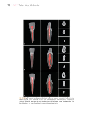 186	 PART I  The Core Science of Endodontics
FIG. 5-124  µCT scans of mandibular central incisors. A, Common anatomic presentation. B, Central incisor
with two canals. C, Central incisor with an apical delta. All teeth are shown from both a buccal (vestibular) and
a proximal perspective, along with the cross-sectional anatomy at the coronal, middle, and apical levels. (See
Video 5-9 online at the Expert Consult site for rotational views of these teeth.)
A
B
C
 