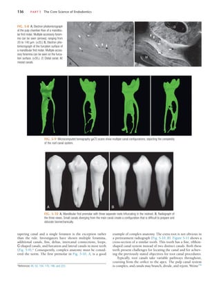 136	 PART I  The Core Science of Endodontics
FIG. 5-8  A, Electron photomicrograph
of the pulp chamber floor of a mandibu-
lar first molar. Multiple accessory foram-
ina can be seen (arrows), ranging from
20 to 140 µm. (×20.) B, Electron pho-
tomicrograph of the furcation surface of
a mandibular first molar. Multiple acces-
sory foramina can be seen on the furca-
tion surface. (×30.). D, Distal canal; M,
mesial canals. A
D
M
B
example of complex anatomy. The extra root is not obvious in
a pretreatment radiograph (Fig. 5-10, B). Figure 5-11 shows a
cross-section of a similar tooth. This tooth has a fine, ribbon-
shaped canal system instead of two distinct canals. Both these
teeth present challenges for locating the canal and for achiev-
ing the previously stated objectives for root canal procedures.
Typically, root canals take variable pathways throughout,
coursing from the orifice to the apex. The pulp canal system
is complex, and canals may branch, divide, and rejoin. Weine238
tapering canal and a single foramen is the exception rather
than the rule. Investigators have shown multiple foramina,
additional canals, fins, deltas, intercanal connections, loops,
C-shaped canals, and furcation and lateral canals in most teeth
(Fig. 5-9).* Consequently, complex anatomy must be consid-
ered the norm. The first premolar in Fig. 5-10, A, is a good
FIG. 5-9  Microcomputed tomography (µCT) scans show multiple canal configurations, depicting the complexity
of the root canal system.
FIG. 5-10  A, Mandibular first premolar with three separate roots trifurcating in the midroot. B, Radiograph of
the three views. Small canals diverging from the main canal create a configuration that is difficult to prepare and
obturate biomechanically.
A B
*References 48, 53, 154, 170, 196, and 223.
 