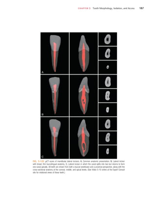 CHAPTER 5  Tooth Morphology, Isolation, and Access	 187
FIG. 5-125  µCT scans of mandibular lateral incisors. A, Common anatomic presentation. B, Lateral incisor
with broad, thin buccolingual anatomy. C, Lateral incisor in which the canal splits into two but returns to form
one canal apically. All teeth are shown from both a buccal (vestibular) and a proximal perspective, along with the
cross-sectional anatomy at the coronal, middle, and apical levels. (See Video 5-10 online at the Expert Consult
site for rotational views of these teeth.)
A
B
C
 