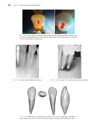 188	 PART I  The Core Science of Endodontics
FIG. 5-126  Access cavity for mandibular incisors as viewed through the dental operating microscope. A, One
canal orifice. (×8.5 magnification with cervical fiberoptic transillumination.) B, Two canal orifices. (×8.5 magnifica-
tion with cervical fiberoptic transillumination.)
A B
FIG. 5-127  Double-rooted mandibular lateral incisor. FIG. 5-128  Two canals in the mandibular lateral and central incisors.
FIG. 5-129  Mandibular canine. Average time of eruption—9 to 10 years; average age of calcification—13
years; average length—25.6 mm. Root curvature (most common to least common): straight, distal, labial.
 