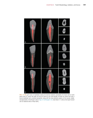 CHAPTER 5  Tooth Morphology, Isolation, and Access	 189
FIG. 5-130  µCT scans of mandibular canines. A, Common anatomic presentation. B, Canine with an extra
apical canal. C, Canine that splits into two but returns to one canal apically. All teeth are shown from both a
buccal (vestibular) and a proximal perspective, along with the cross-sectional anatomy at the coronal, middle,
and apical levels. A fourth type is seen in Figs. 5-133 through 5-135. (See Video 5-11 online at the Expert Consult
site for rotational views of these teeth.)
A
B
C
 