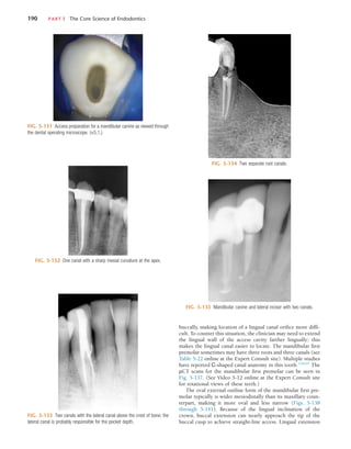 190	 PART I  The Core Science of Endodontics
FIG. 5-131  Access preparation for a mandibular canine as viewed through
the dental operating microscope. (×5.1.)
FIG. 5-132  One canal with a sharp mesial curvature at the apex.
FIG. 5-133  Two canals with the lateral canal above the crest of bone; the
lateral canal is probably responsible for the pocket depth.
FIG. 5-134  Two separate root canals.
FIG. 5-135  Mandibular canine and lateral incisor with two canals.
buccally, making location of a lingual canal orifice more diffi-
cult. To counter this situation, the clinician may need to extend
the lingual wall of the access cavity farther lingually; this
makes the lingual canal easier to locate. The mandibular first
premolar sometimes may have three roots and three canals (see
Table 5-22 online at the Expert Consult site). Multiple studies
have reported C-shaped canal anatomy in this tooth.13,65,67
The
µCT scans for the mandibular first premolar can be seen in
Fig. 5-137. (See Video 5-12 online at the Expert Consult site
for rotational views of these teeth.)
The oval external outline form of the mandibular first pre-
molar typically is wider mesiodistally than its maxillary coun-
terpart, making it more oval and less narrow (Figs. 5-138
through 5-141). Because of the lingual inclination of the
crown, buccal extension can nearly approach the tip of the
buccal cusp to achieve straight-line access. Lingual extension
 