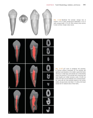 CHAPTER 5  Tooth Morphology, Isolation, and Access	 191
FIG. 5-136  Mandibular first premolar. Average time of
eruption—10 to 12 years; average age of calcification—12 to 13
years; average length—21.6 mm. Root curvature (most common
to least common): straight, distal, buccal.
A
B
C
FIG. 5-137  µCT scans of mandibular first preomlars.
A, Common anatomic presentation. B, First premolar with
significant canal deviations in the middle to apical third before
returning to a single large canal apically and a small deviating
canal to the proximal. C, First premolar with a branching main
canal lingually and multiple accessory canals. All teeth are
shown from both a buccal (vestibular) and a proximal perspec-
tive, along with the cross-sectional anatomy at the coronal,
middle, and apical levels. (See Video 5-12 online at the Expert
Consult site for rotational views of these teeth.)
 