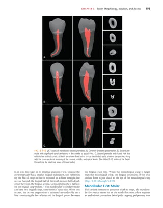 CHAPTER 5  Tooth Morphology, Isolation, and Access	 193
FIG. 5-143  µCT scans of mandibular second premolars. A, Common anatomic presentation. B, Second pre-
molar with significant canal deviations in the middle to apical third. C, Second premolar with fused root that
exhibits two distinct canals. All teeth are shown from both a buccal (vestibular) and a proximal perspective, along
with the cross-sectional anatomy at the coronal, middle, and apical levels. (See Video 5-13 online at the Expert
Consult site for rotational views of these teeth.)
A
B
C
in at least two ways in its external anatomy. First, because the
crown typically has a smaller lingual inclination, less extension
up the buccal cusp incline is required to achieve straight-line
access. Second, the lingual half of the tooth is more fully devel-
oped; therefore, the lingual access extension typically is halfway
up the lingual cusp incline.54
The mandibular second premolar
can have two lingual cusps, sometimes of equal size. When this
occurs, the access preparation is centered mesiodistally on a
line connecting the buccal cusp and the lingual groove between
the lingual cusp tips. When the mesiolingual cusp is larger
than the distolingual cusp, the lingual extension of the oval
outline form is just distal to the tip of the mesiolingual cusp
(Figs. 5-144 through 5-149).
Mandibular First Molar
The earliest permanent posterior tooth to erupt, the mandibu-
lar first molar seems to be the tooth that most often requires
an endodontic procedure (vital pulp capping, pulpotomy, root
 